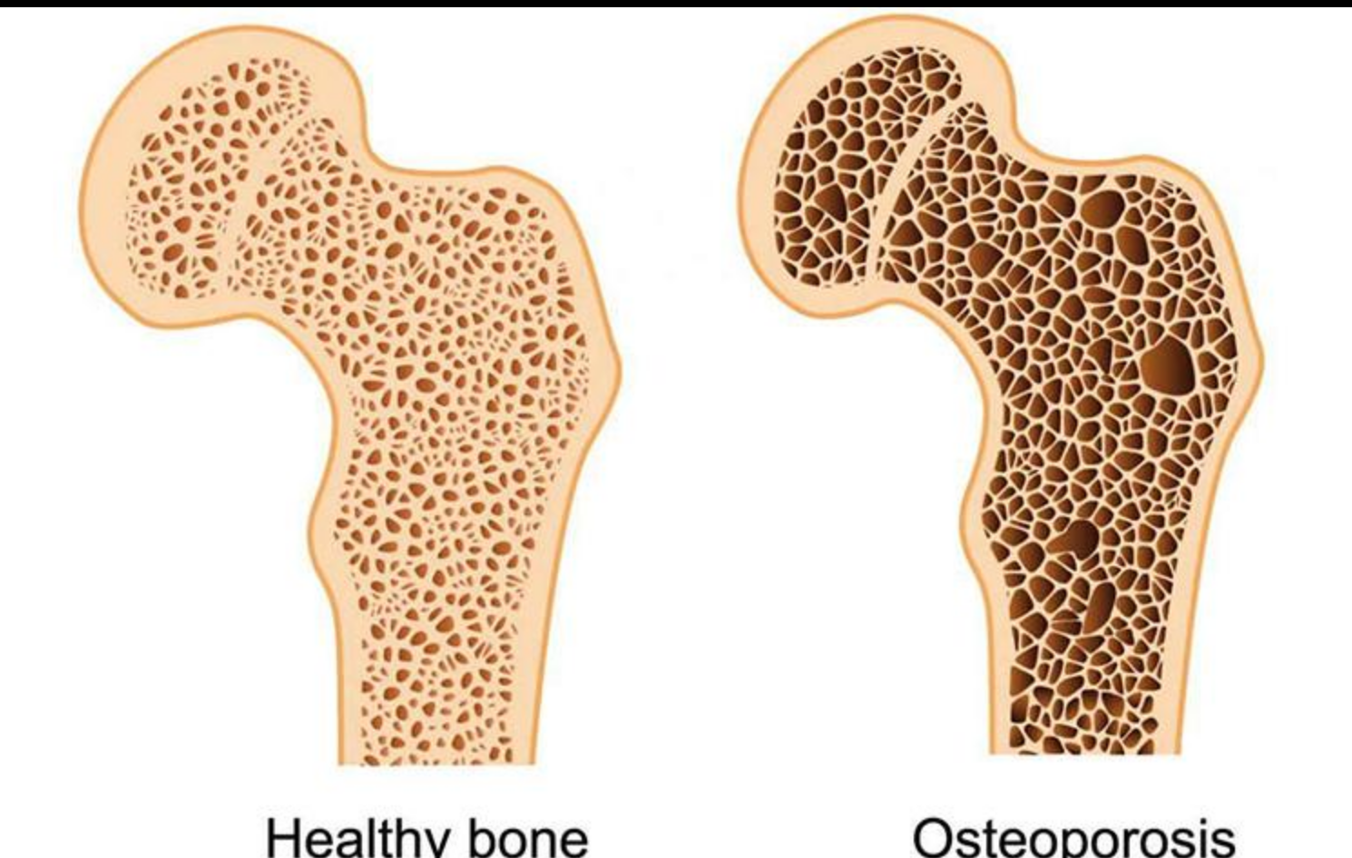 Osteoporosis