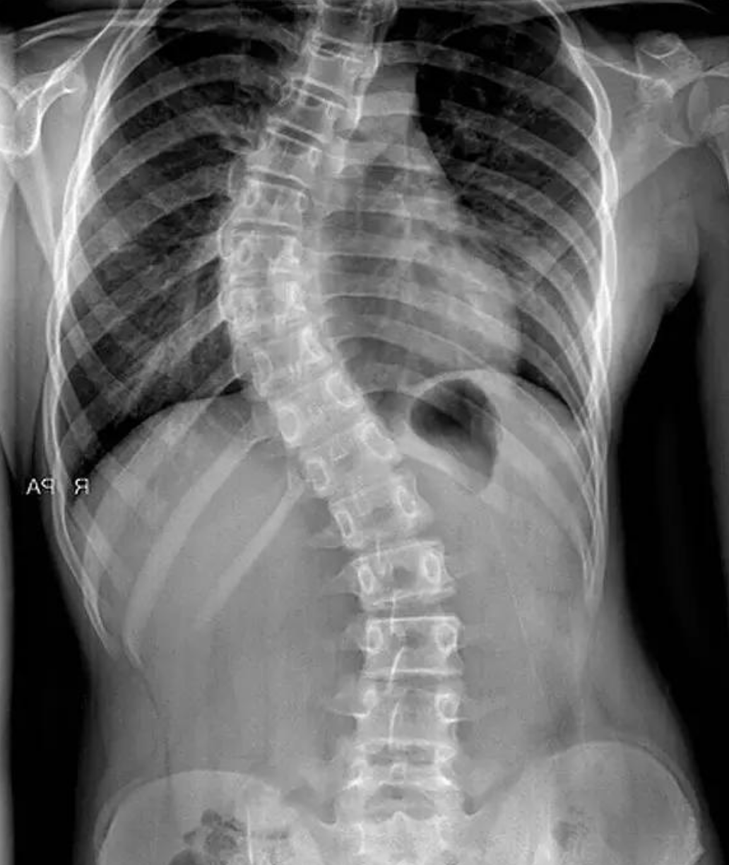 Adult Scoliosis